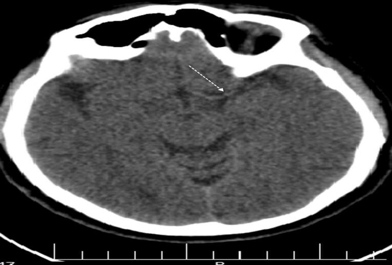 Acute Cerebral Artery Occlusion Following Levantine Viper (<i>Macrovipera lebetina</i>) Bite: Gács Sign in Snakebite.