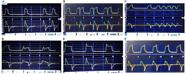 Ability to identify patient-ventilator asynchronies in intensive care unit professionals: A multicenter cross-sectional analytical study.