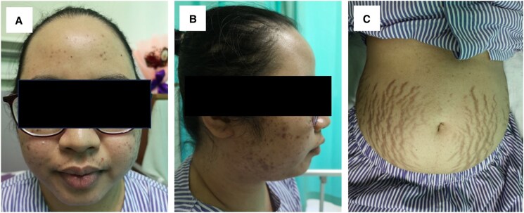 ACTH-dependent Cyclic Cushing Syndrome With Successful Pregnancy and Early Postpartum Relapse.