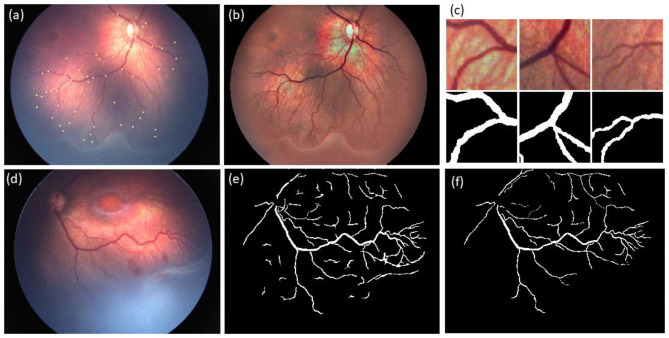 SmartPlus: a computer-based image analysis method to predict continuous-valued vascular abnormality index in Retinopathy of Prematurity.