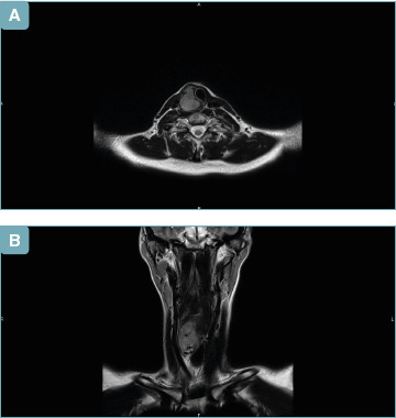 Head and neck synovial sarcoma in a woman with previous lymphoma and papillary thyroid carcinoma.