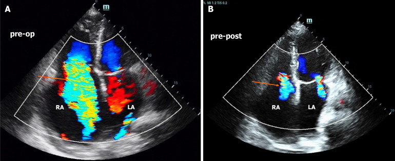 High-output heart failure secondary to iatrogenic arteriovenous fistula: A case report.
