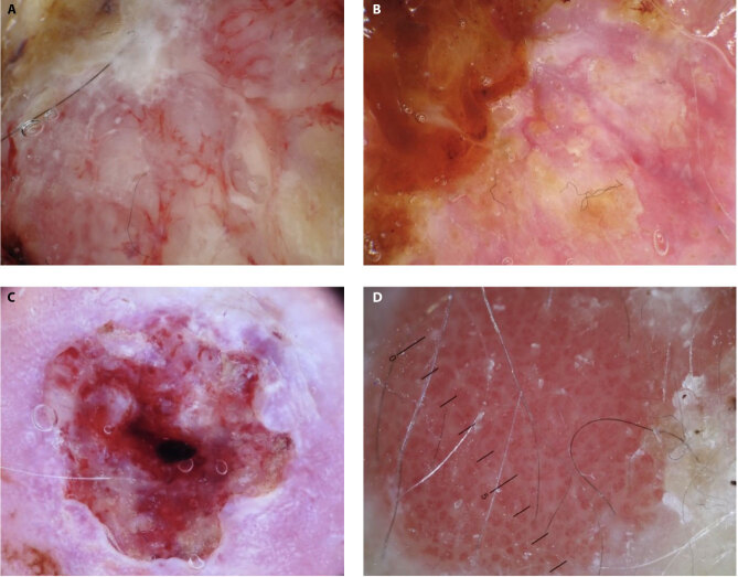 Erosive Pustular Dermatosis of the Scalp Mimicking Squamous Cell Carcinoma: Can Dermoscopy Be Helpful?