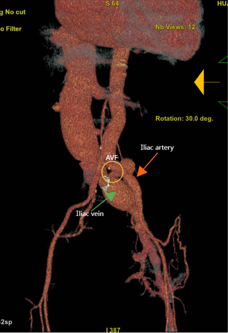 High-output heart failure secondary to iatrogenic arteriovenous fistula: A case report.