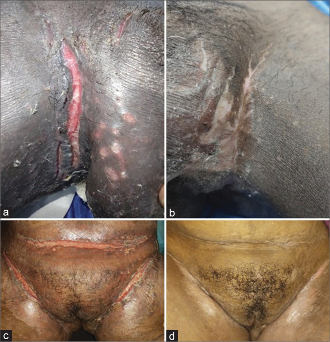 Platelet-rich fibrin therapy as an adjuvant treatment in the management of metastatic Crohn's disease: A case series.