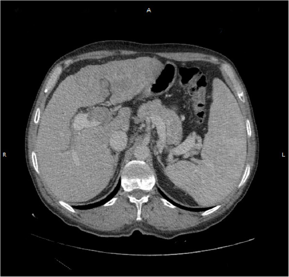 Lytic bone lesion of the skull as a rare manifestation of hepatocellular carcinoma: a case report.