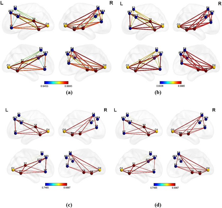 Music interventions and obstructive sleep apnea: a brain connectivity analysis.