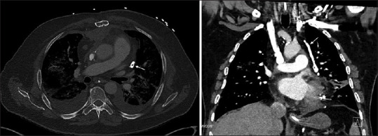 Misplacement of a Left Internal Jugular Central Venous Catheter in the Pericardiophrenic Vein.