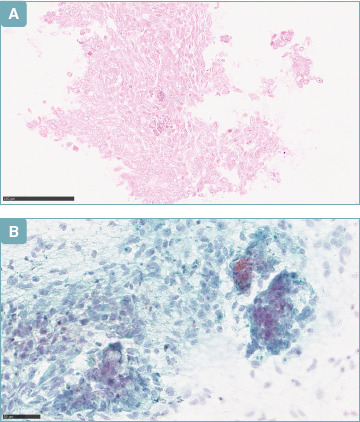 Head and neck synovial sarcoma in a woman with previous lymphoma and papillary thyroid carcinoma.