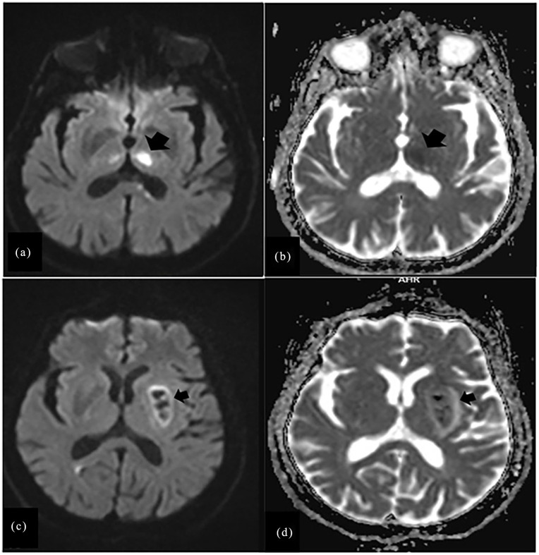 Stroke-related restless leg syndrome in hemorrhagic and ischemic stroke patients.