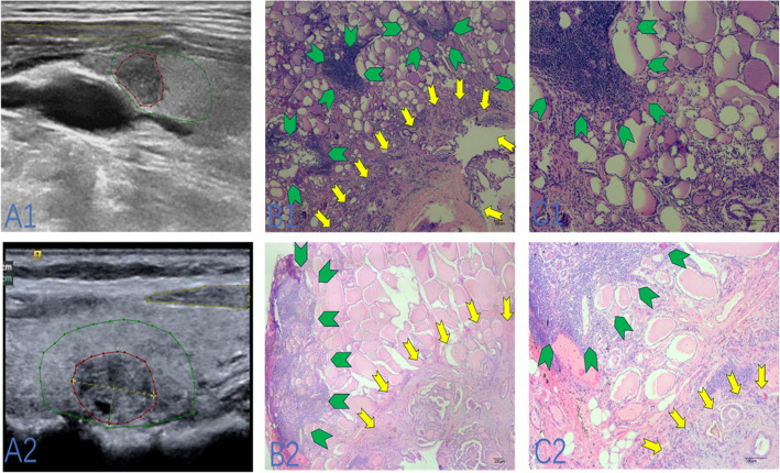 Prediction of Seronegative Hashimoto's thyroiditis using machine learning models based on ultrasound radiomics: a multicenter study.