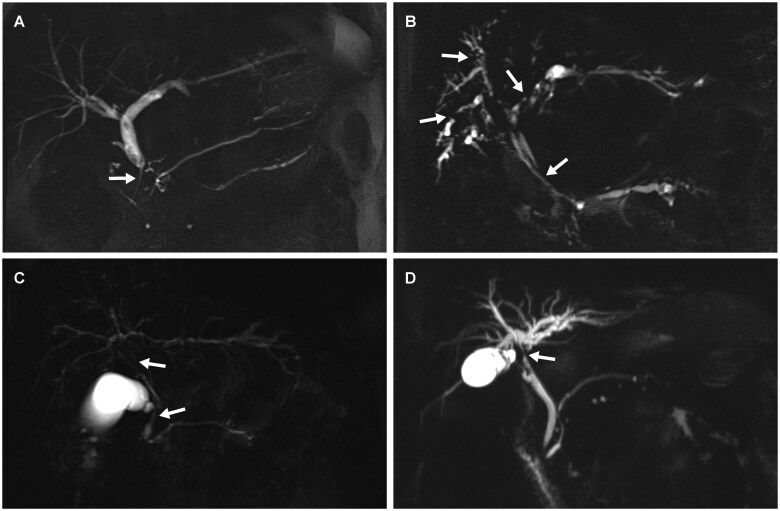 Management of IgG4-related cholangitis: diagnosis, therapy, and long-term surveillance.