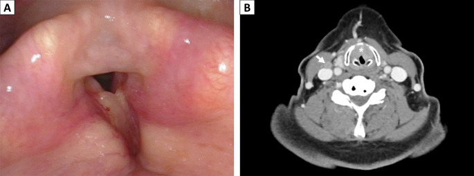 Primary Laryngeal Squamous Cell Carcinoma with DEK::AFF2 Fusion: The First Case Report.
