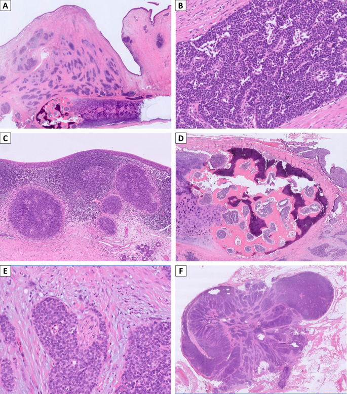 Primary Laryngeal Squamous Cell Carcinoma with DEK::AFF2 Fusion: The First Case Report.
