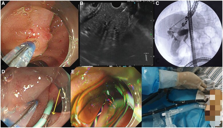 Endoscopic ultrasound-guided rendezvous technique with dual endoscopic technique rescue the difficult cannulation after Billroth type II gastrectomy.