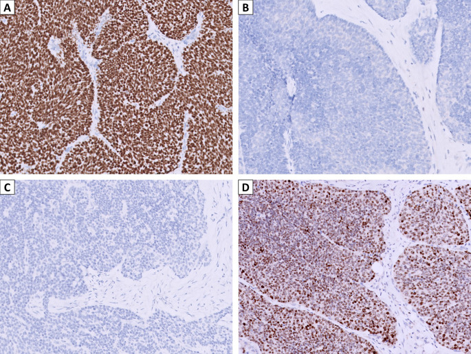 Primary Laryngeal Squamous Cell Carcinoma with DEK::AFF2 Fusion: The First Case Report.