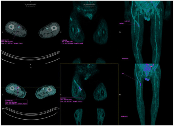Successful rezafungin treatment of an azole-resistant <i>Candida parapsilosis</i> vascular graft infection.