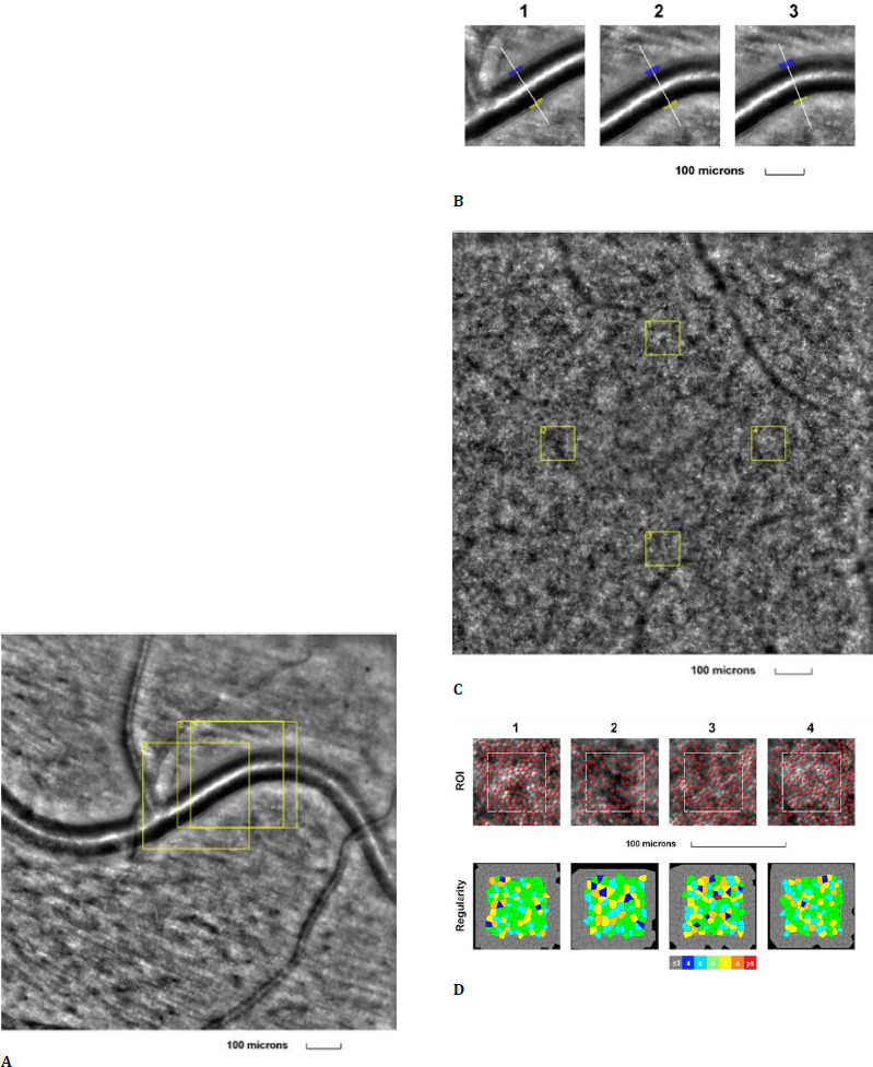 Retinal Vascular Diseases Highlighted by Adaptive Optics Ophthalmoscopy.