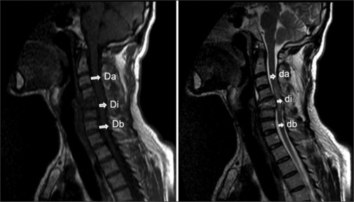 The relationship between magnetic resonance imaging, clinical findings, treatment modalities, and neurological outcomes in acute traumatic spinal cord injury in the emergency department.