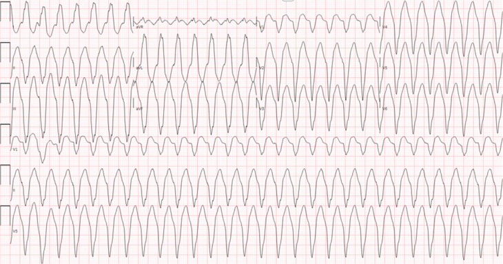 Dual-morphology Bundle Branch Re-entrant Ventricular Tachycardia in Non-dilated Cardiomyopathy.