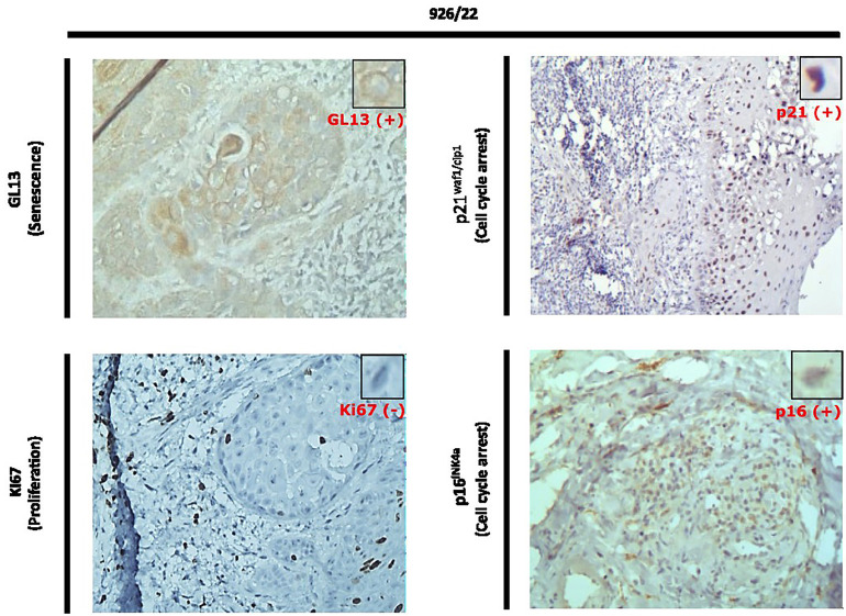 HPV-Negative Oral Squamous Cell Carcinoma Arising from Oral Submucous Fibrosis with p16INK4A Positivity and Cellular Senescence: A Case Report.
