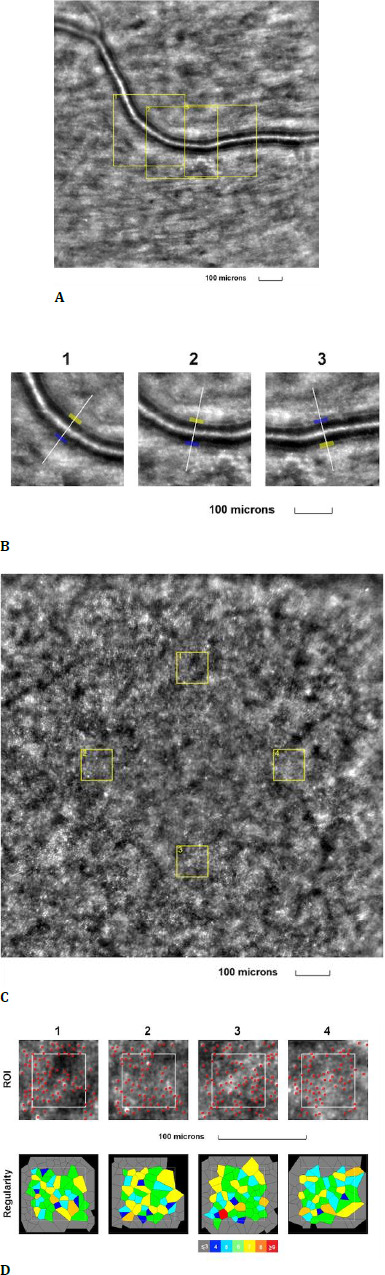 Retinal Vascular Diseases Highlighted by Adaptive Optics Ophthalmoscopy.
