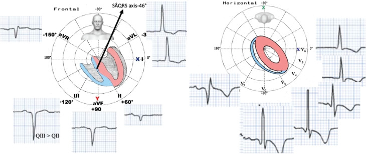 Left Septal Fascicular Block Following Left Bundle Branch Area Pacing.