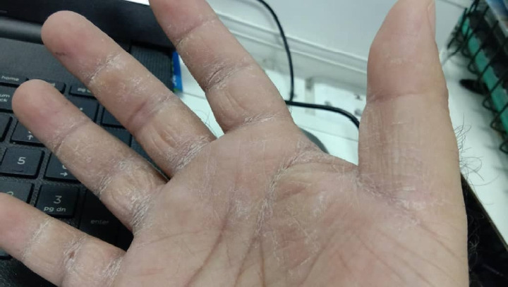 Challenges in diagnosing occupational allergic contact dermatitis: a case report.