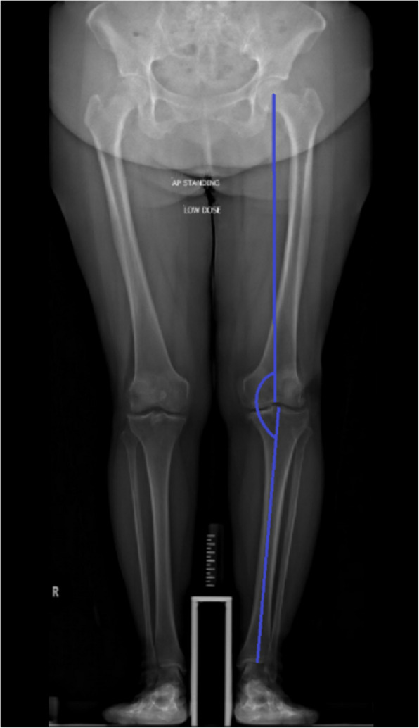 Handheld imageless robotic total knee arthroplasty improves accuracy and early clinical outcomes when compared with navigation.