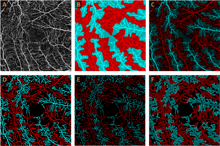 Differential artery-vein analysis in OCTA for predicting the anti-VEGF treatment outcome of diabetic macular edema.