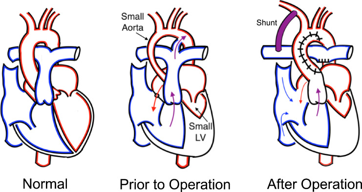 Pediatric Cardiovascular Multiscale Modeling using a Functional Mock-up Interface.