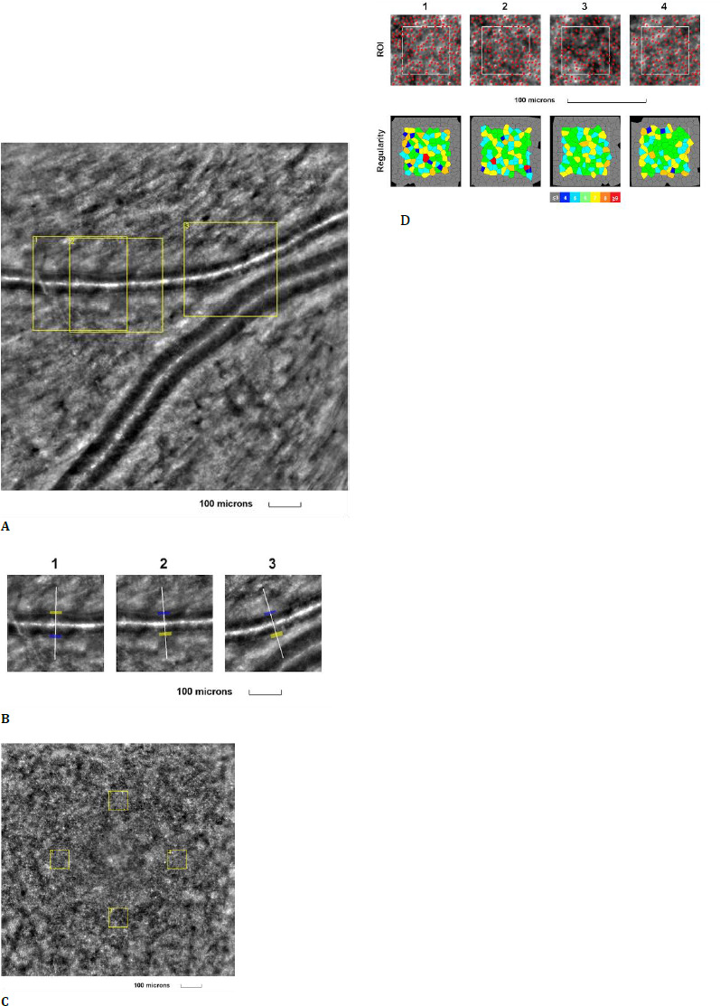 Retinal Vascular Diseases Highlighted by Adaptive Optics Ophthalmoscopy.