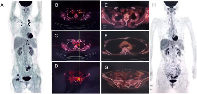 Haploidentical Hematopoietic Stem Cell Transplantation for Relapsed/Refractory Extramedullary Multiple Myeloma: A Conditioning Regimen Combining Selinexor and Helical Tomotherapy-A Case Report and Literature Review.