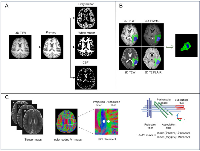 Glymphatic system dysfunction and cerebrospinal fluid retention in gliomas: evidence from perivascular space diffusion and volumetric analysis.
