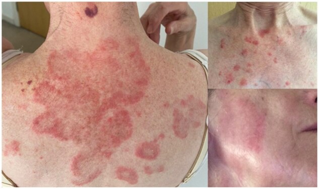 Drug induced subacute cutaneous lupus.