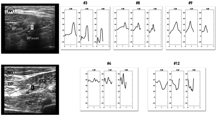 Thigh muscle pump function during ambulation