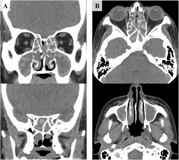 Early Intervention with Mepolizumab, Corticosteroids, and Intravenous Immunoglobulin for Dupilumab-Triggered Eosinophilic Granulomatosis with Polyangiitis: A Case Report.