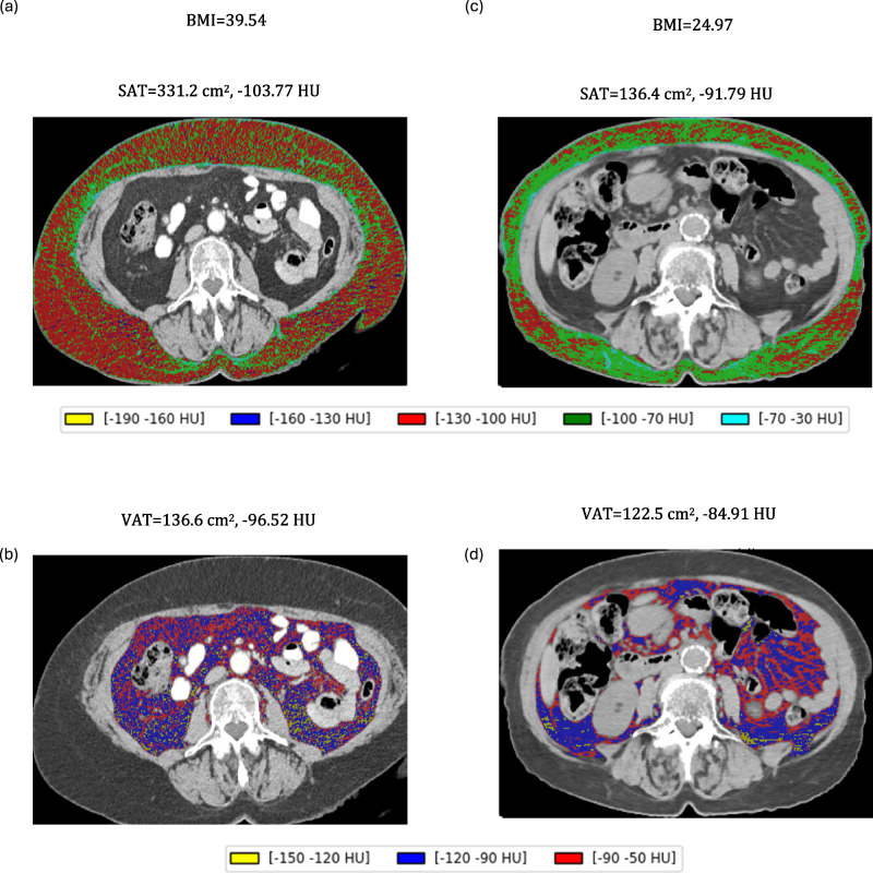 Body composition metrics as a determinant of trastuzumab deruxtecan related toxicity and response.