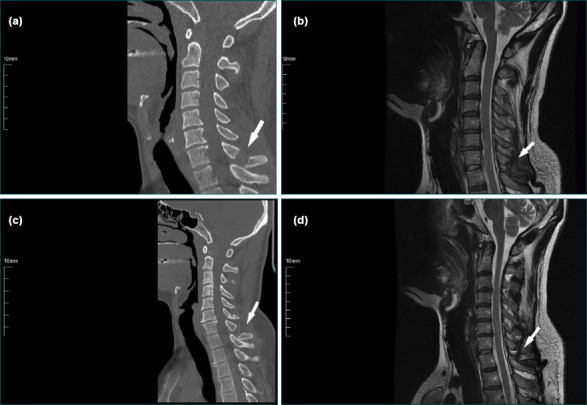 Traumatic isolated spinous process fractures.