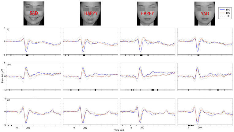 Event-related potential biomarkers in temporal lobe epilepsy: N170, vertex positive potential, late positive potential, and P3 signatures of depression comorbidity.