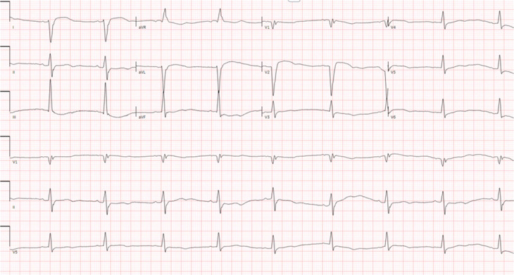 Dual-morphology Bundle Branch Re-entrant Ventricular Tachycardia in Non-dilated Cardiomyopathy.