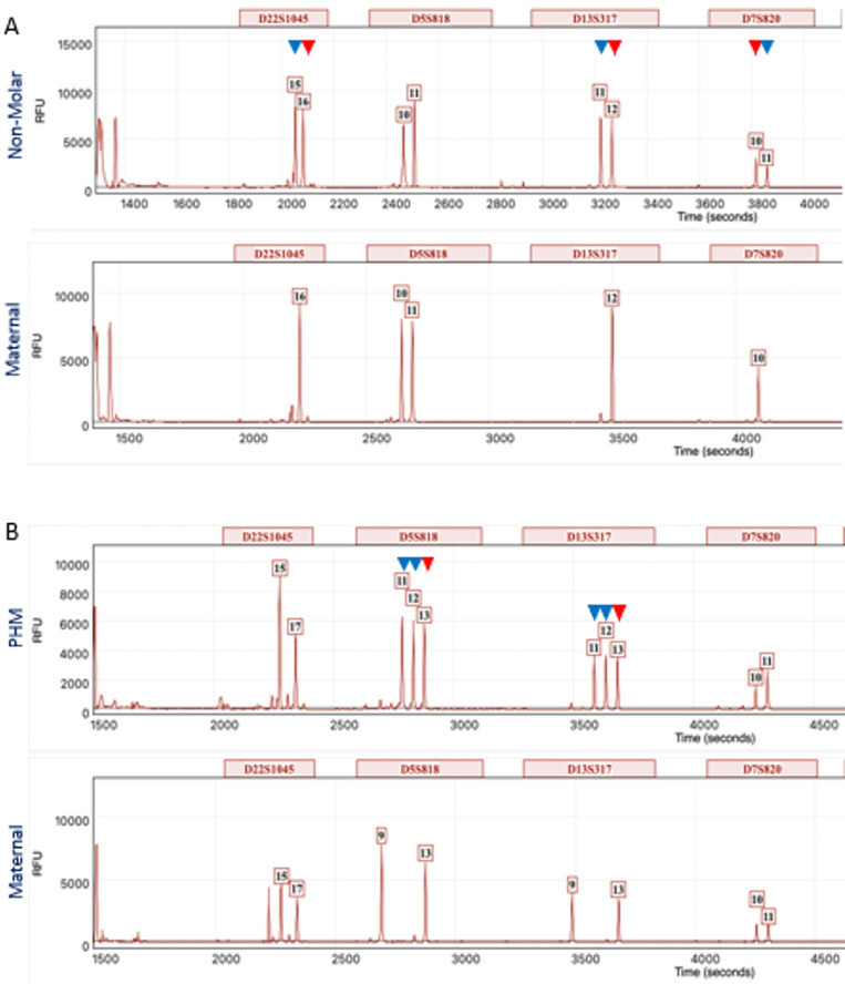 Morphology combined with <i>HER2</i> D-DISH ploidy analysis to diagnose partial hydatidiform mole: an evaluation audit using molecular genotyping.