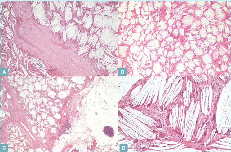 Cholesterol granuloma. Another brick in the wall of mediastinal lesions.
