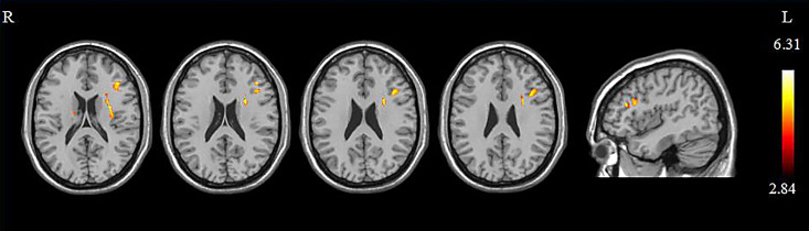 Transcranial Magnetic Stimulation Induces White Matter Microstructure Alterations in Patients with Mild Cognitive Impairment.