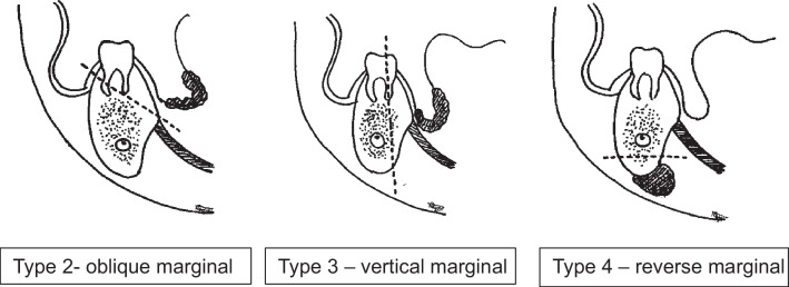 Marginal Mandibulectomy in Oral Cavity Cancers - Classification and Indications.
