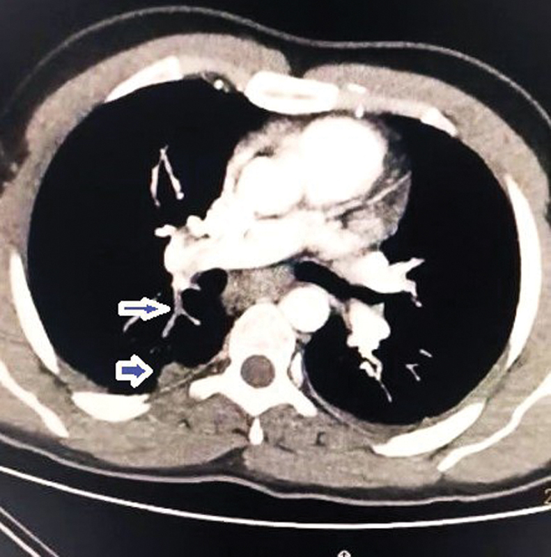 Varicella Pneumonia with Deep Venous Thrombosis and Pulmonary Embolism as Rare Presentations for Male: Case Report.