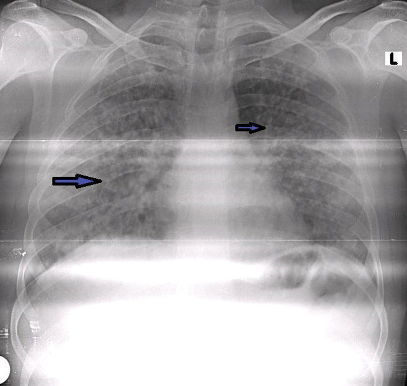 Varicella Pneumonia with Deep Venous Thrombosis and Pulmonary Embolism as Rare Presentations for Male: Case Report.