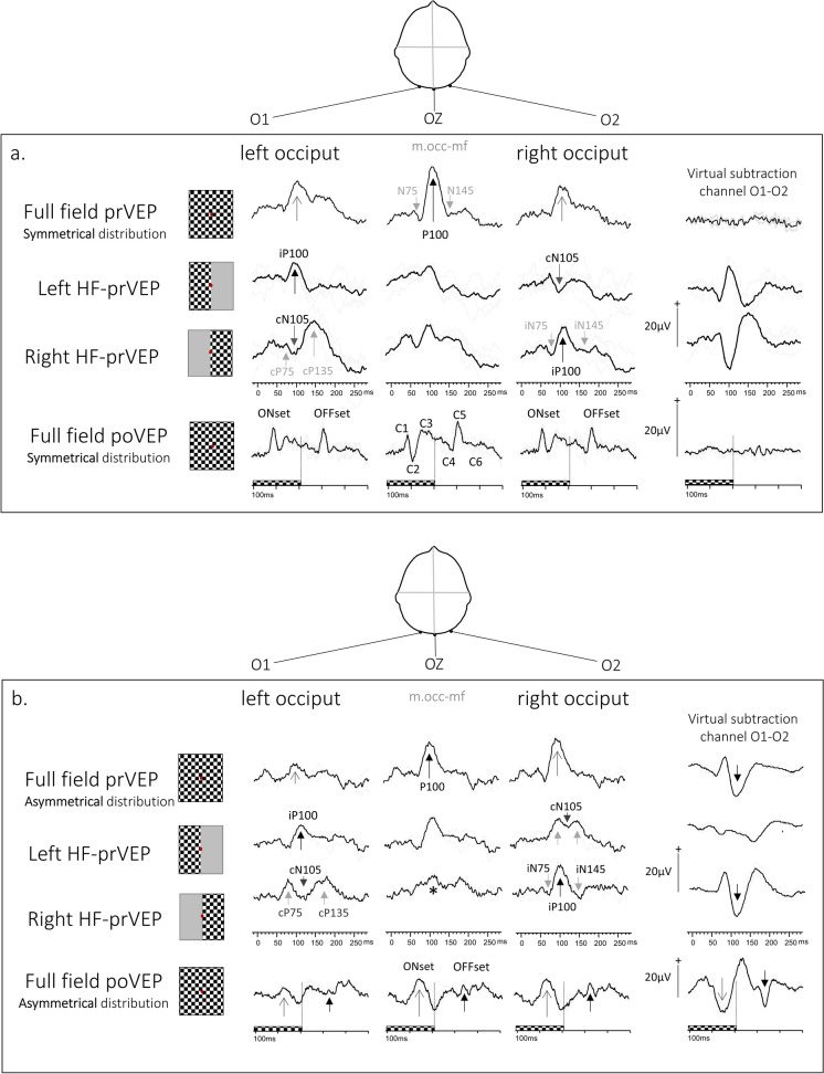 Multi-channel pattern VEPs with full and half field stimulation: methods of interpretation and diagnostic evaluation.