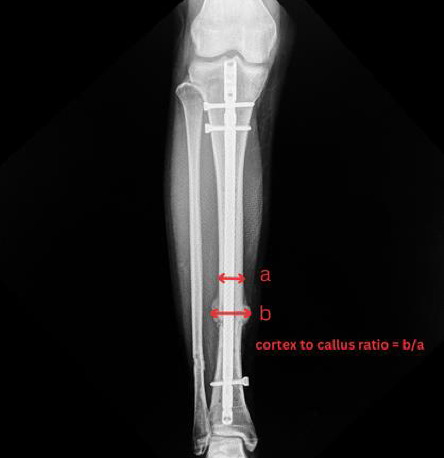 Evaluation of the Role of PRP in Acute Tibial Shaft Fractures Fixation With IM Nail: A Double-Blinded Randomized Controlled Trial.