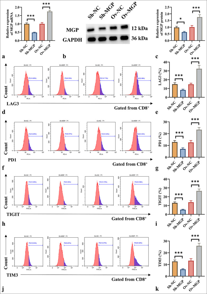 Matrix gla protein mediates CD8<sup>+</sup> T-cell exhaustion to facilitate immune evasion in intrahepatic cholangiocarcinoma.